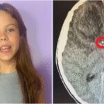 abscesso-cerebral:-entenda-a-condicao-que-levou-a-morte-da-atriz-mirim-millena-brandao