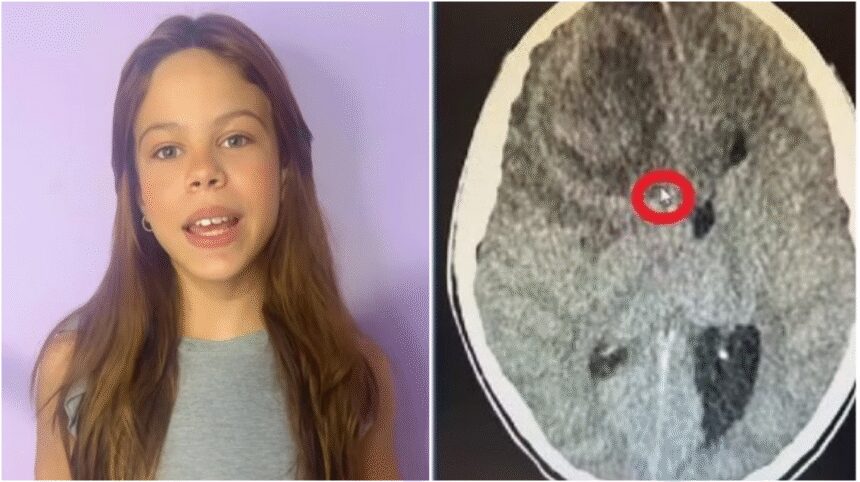 abscesso-cerebral:-entenda-a-condicao-que-levou-a-morte-da-atriz-mirim-millena-brandao