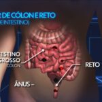 tipo-de-cancer-que-matou-preta-gil-deve-causar-36%-mais-mortes-ate-2040,-aponta-levantamento
