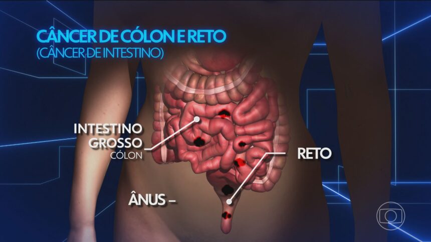 tipo-de-cancer-que-matou-preta-gil-deve-causar-36%-mais-mortes-ate-2040,-aponta-levantamento