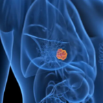 risco-de-novo-cancer-apos-tumor-de-mama-inicial-e-baixo,-mostra-estudo-com-476-mil-mulheres