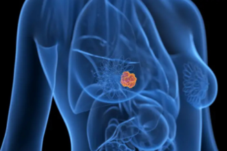 risco-de-novo-cancer-apos-tumor-de-mama-inicial-e-baixo,-mostra-estudo-com-476-mil-mulheres
