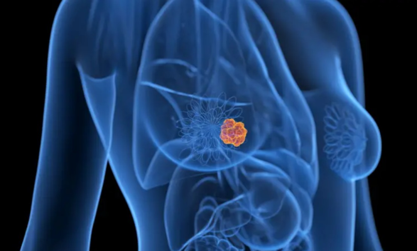 risco-de-novo-cancer-apos-tumor-de-mama-inicial-e-baixo,-mostra-estudo-com-476-mil-mulheres