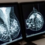 pesquisa-brasileira-descobre-por-que-alguns-tipos-de-cancer-de-mama-nao-respondem-a-tratamentos