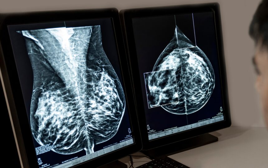 pesquisa-brasileira-descobre-por-que-alguns-tipos-de-cancer-de-mama-nao-respondem-a-tratamentos
