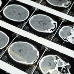 doencas-prionicas:-os-enigmas-das-proteinas-que-‘entortam’-e-destroem-o-cerebro