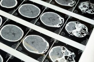 doencas-prionicas:-os-enigmas-das-proteinas-que-‘entortam’-e-destroem-o-cerebro