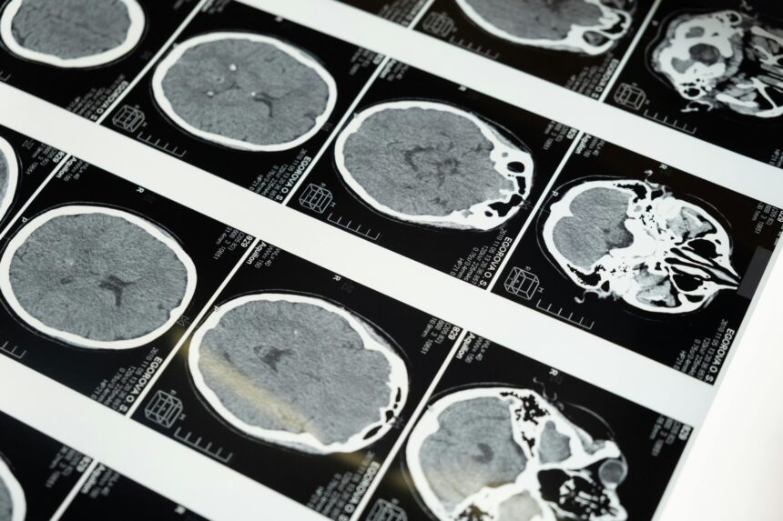doencas-prionicas:-os-enigmas-das-proteinas-que-‘entortam’-e-destroem-o-cerebro