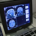 avc,-alzheimer-e-enxaqueca:-por-que-oms-emitiu-alerta-sobre-essas-doencas-e-condicoes-neurologicas?