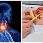 bloqueio-de-hormonio-da-tireoide-impede-crescimento-de-tumor-de-prostata,-aponta-estudo