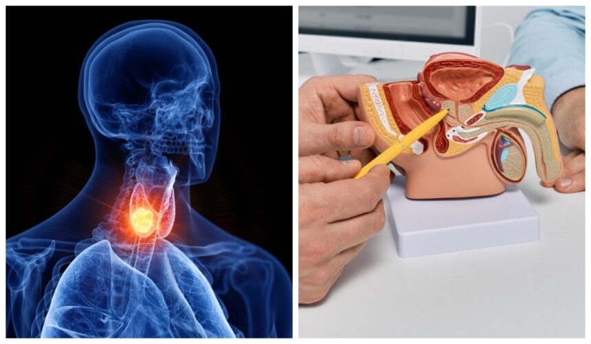 bloqueio-de-hormonio-da-tireoide-impede-crescimento-de-tumor-de-prostata,-aponta-estudo