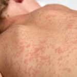 casos-de-sarampo-caem-71%-em-24-anos-por-melhoria-da-cobertura-vacinal,-diz-oms