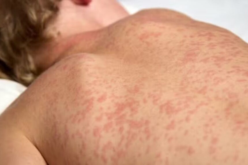 casos-de-sarampo-caem-71%-em-24-anos-por-melhoria-da-cobertura-vacinal,-diz-oms