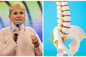 cirurgia-da-xuxa-na-coluna:-entenda-o-que-e-a-estenose-de-canal-e-como-prevenir