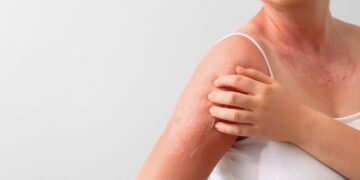 saiba-quais-sao-os-quatro-tipos-de-queimadura