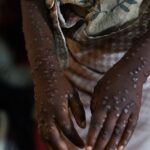 mpox-no-brasil:-numero-de-casos-confirmados-em-2026-sobe-para-140