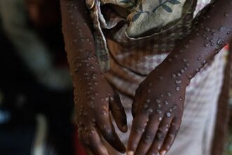 mpox-no-brasil:-numero-de-casos-confirmados-em-2026-sobe-para-140