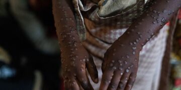 mpox-no-brasil:-numero-de-casos-confirmados-em-2026-sobe-para-140