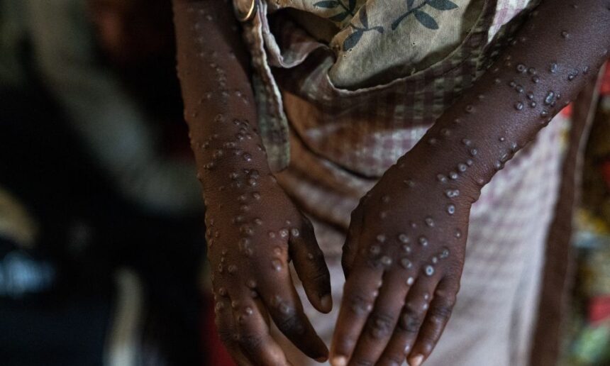 mpox-no-brasil:-numero-de-casos-confirmados-em-2026-sobe-para-140